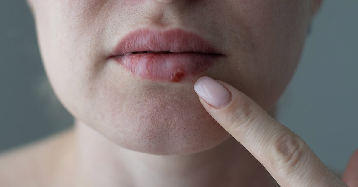 Casi tres décadas después, llega un antiviral oral que pelea contra el herpes que se hace el duro